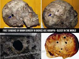 Brain Surgery In Ancient India India Facts Ancient India Harappan