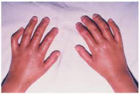 Likevel er det mye som tyder på at daglig bruk av kroppens ledd og muskler forebygger. Systemisk Sklerose Bindevevssykdommer Nobindevevssykdommer No