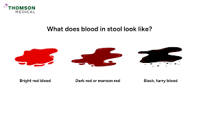 Image result for dark black stool human poop