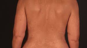 Pityriasis alba is a common skin disorder in children (90%) and young adults. Pityriasis Versicolor Ubersicht Altmeyers Enzyklopadie Fachbereich Dermatologie