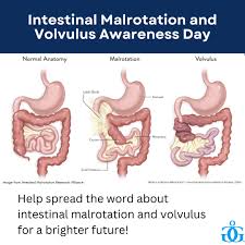 Image result for Intestinal Malrotation