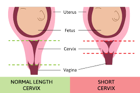 Short Cervical Length Is A Normal Delivery Possible Sitaram Bhartia Blog