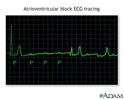 Image result for Atrioventricular Block