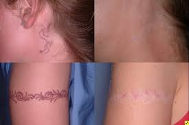 Leviticus is currently appointment only. Laser Tattoo Removal In Minneapolis Edina Plymouth Zelskin Com