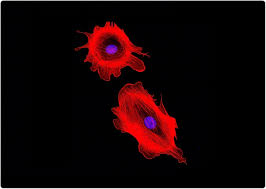 Bone marrow is the spongy tissue inside your bones that makes blood cells. Bone Marrow Derived Fibroblasts Shown To Promote Breast Cancer Growth