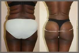 Pin On Brazilian Butt Augmentation