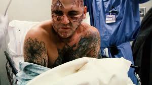 25 Surgeries to Remove His Neo-Nazi Tattoos