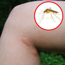 Rather than experience it yourself, why not let us the initial pain will likely be minor, and the redness will be localized to the bite itself. How To Identify A Bug Bite And What To Do With It