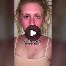 Anaphylactic shock is NO JOKE. #allergicreaction #hospital #epipen #c...