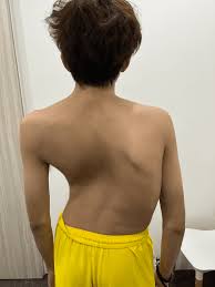 دعم الطفل المصاب باعوجاج العمود الفقري