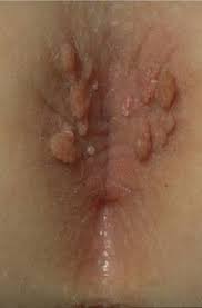 Desi este cunoscuta mai mult ca o afectiune specifica femeilor, asta nu inseamna ca barbatii pot suferi si de celelalte forme de candidoza, nu doar de cea genitala, astfel incat nu putem atribui. Stiluri Noi Calitate ExcelentÄ Vanzare La PreÈ Mic Infectie Genitala Barbati Generalpromo Ro