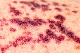 The cause of petechiae is minor hemorrhage, i.e. Q A What Is Purpura