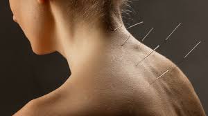 Image result for Acupuncture