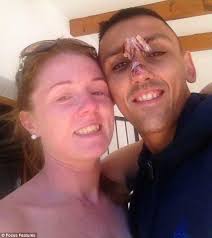 Jamie Norman suffered scarring after accident