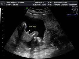Sama seperti cara di atas, gunakan soda bikarbonat (tepung penaik) bersama air. Ini Antara Sebab Kenapa Detail Scan Untuk Bayi Lebih Penting Dari Scan 3d4d5d