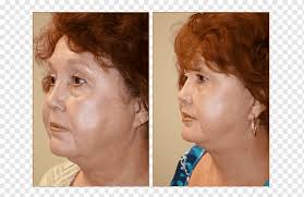 Decide where you're going to. Cheek Rhytidectomy Lifestyle Lift Face Chin Face People Head Hair Png Pngwing