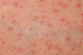 Image result for folliculitis symptoms