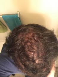 It's called alopecia areata, and it's characterized. I Ve Went To The Dermatologist And I Ve Gotten Cortisone Shots In My Head For The Past Year Or So And This Is The Result I M Not Losing Hair Anymore But Is There