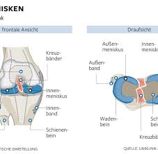 Es kommt zu starken, stechenden schmerzen und einer schwellung im bereich des knies. Knie Kaputten Meniskus Unbedingt Behandeln Lassen Welt