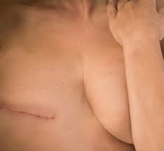 Image result for Mastectomy