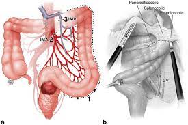 Definition from wiktionary, the free dictionary. Pearls For The Small Bowel And Colon That Will Not Reach Abdominal Key