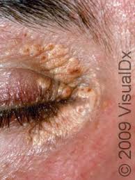 Image result for xanthelasma of eyelid