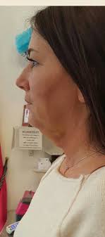 Woman reveals horror after a facelift left her looking like she'd been in a  'car crash'