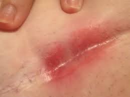 C Section Scar Kinda Gross Pic Babycenter