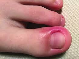 Image result for Akutní zánět nehtového lůžka