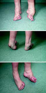 It was released on 17 may 2004 in the uk. The Current State Of Treatment For Clubfoot In Europe Springerlink