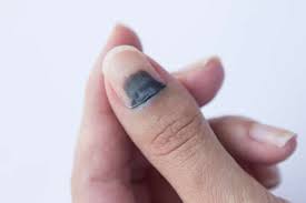 Akibat terjepit atau terbentur biasanya kuku mengalami memar sehingga darah yg ada dibalik kuku jadi tampak hitam dan begini mengatasinya. Cara Mengobati Darah Beku Di Kuku Yang Ampuh Hello Sehat