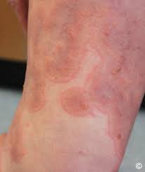 Image result for Pemphigoid