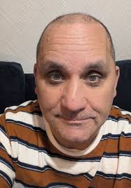 Hi all.. I am 49 with NF1. I have 3 children that also have it, but im more  affected than they are with the fibromas, and plexiforms.. I'm currently in  nursing school ..