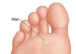 A local growth of the outer layer of the skin (the epidermis) caused by a virus. Understanding Plantar Warts Articles Mount Nittany Health System