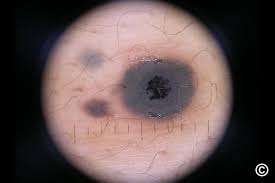 Image result for Blue Nevus
