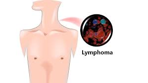 Symptoms of lymphoma are generally caused by the high numbers of abnormal white blood cells that overcome the normal white blood cells and red blood lymphoma treatment plans use a multifaceted approach that is individualized to the type and stage of advancement of lymphoma, and to your age. Lymphoma Causes Symptoms Risk Factors Diagnosis And Treatment