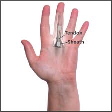 Trigger Finger Causes Your Tendon To Get Caught In A Sheath