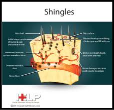 Pin On Shingles