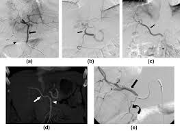 (surgery) the deliberate blocking of a blood vessel. Hepatic Embolotherapy In Interventional Oncology Technology Techniques And Applications Clinical Radiology