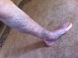 Varicose veins are abnormally swollen and tortuous veins, often visible just beneath the skin. Looking For Treatment For Bad Varicose Veins In Pregnancy