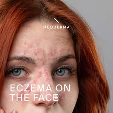 Image result for ekzema face