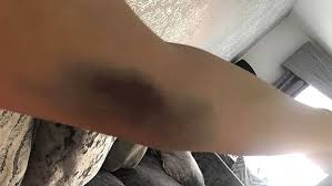 Pad ili udarac, čak i ako nisu praćeni jakom boli, uzrokuju izlijevanje krvi iz malih žila, pa koža na tom mjestu potamni. Sara 22 Se Pozalila Drugarici Da Ima Modrice Nedelju Dana Kasnije Bila Je Mrtva A Lekari Su Otkrili Uzasnu Stvar Uznemirujuce Fotografije