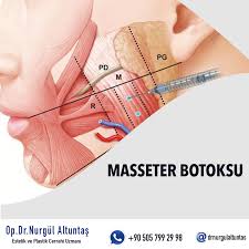 Masseter Botoksu Dis Sikma Tedavisi Cene Botoksu Drnurgulaltuntas Masseterbotoksucreti Estetik Blog