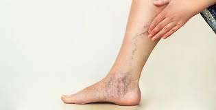 Winter Is A Great Time For Sclerotherapy Suffolk Vascular Vein Center Vascular Surgeons