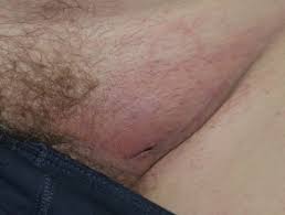 Subcutaneous fat is the fat stored under your skin. Metastatic Melanoma With Unknown Primary Dermnet Nz