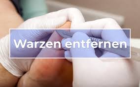 Einige warzenarten können sie selbst zu hause entfernen und ein arztbesuch bleibt somit erspart. Wie Kann Man Warzen Fur Immer Entfernen Kompetenzforum Gesundheit