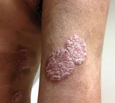 Image result for Auspitz Sign