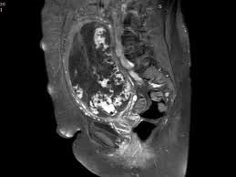 Mri Is Indicated In Patients With Malignant Forms Of Gestational Trophoblastic Neoplasia Gtn For An Assessment Of Tumor Vas Medical Definition Obstetrics Mri