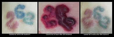 Blisters After Laser Tattoo Removal Treatments Vanish Laser Tattoo Removal Skin Aesthetics