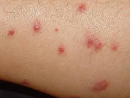 Alergia A Picada De Inseto Saiba O Que Causa E Como Tratar Prontopele